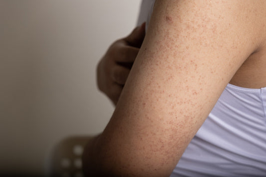 Žąsies oda arba Keratosis pilaris