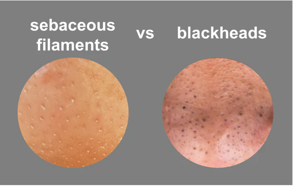 Riebalinės gijos ar inkštirai?